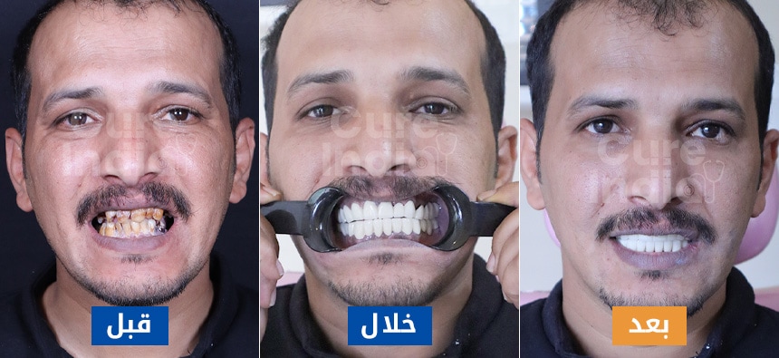 تلبيس الأسنان قبل وبعد الصور